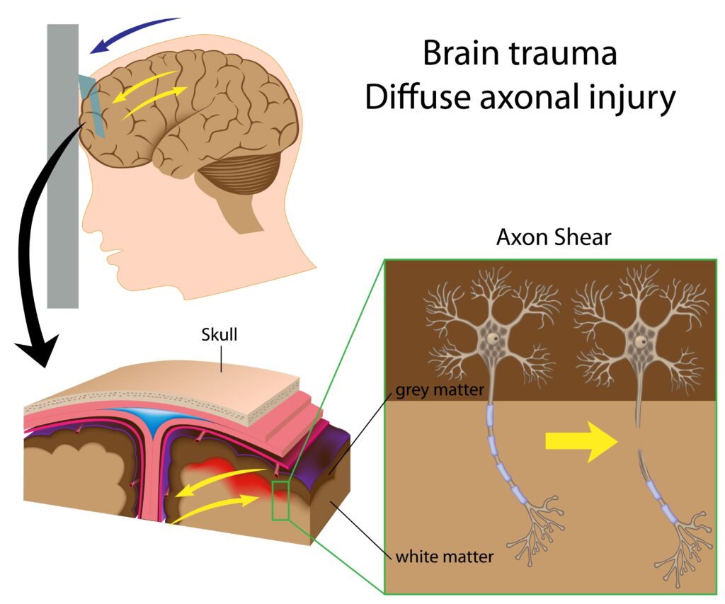 Diffuse Axonal Injury