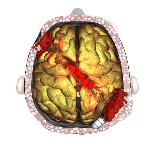 Traumatic Brain Inj Traumatic Brain Injuries - The Cochran Firm New Orleans Practice Area